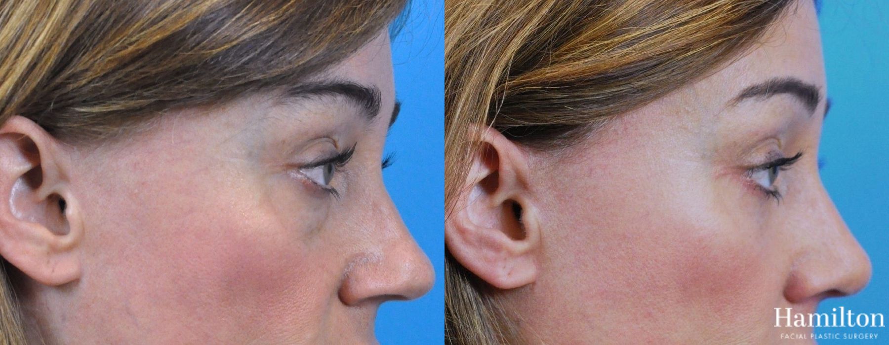 Before and after Rhinoplasty case 37329 - Angle 4