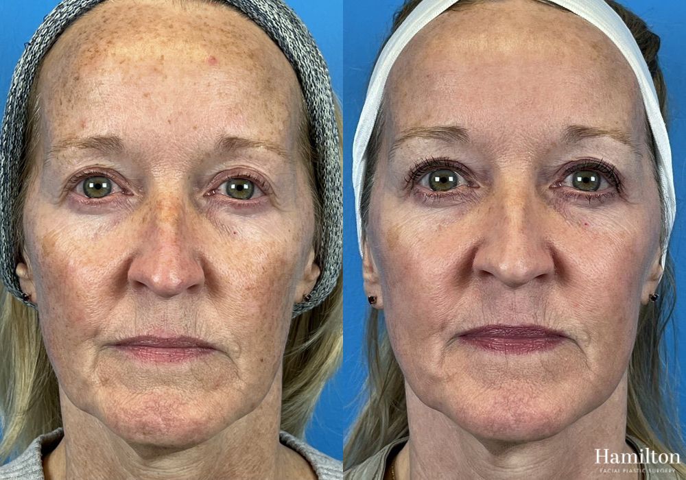 Before and after Laser - Broad Band Light (BBL) case 37099 - Angle 4