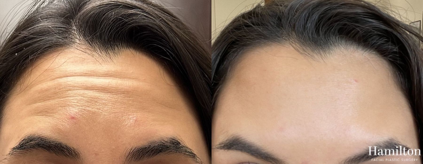 Before and after Neurotoxins/BOTOX case 37201