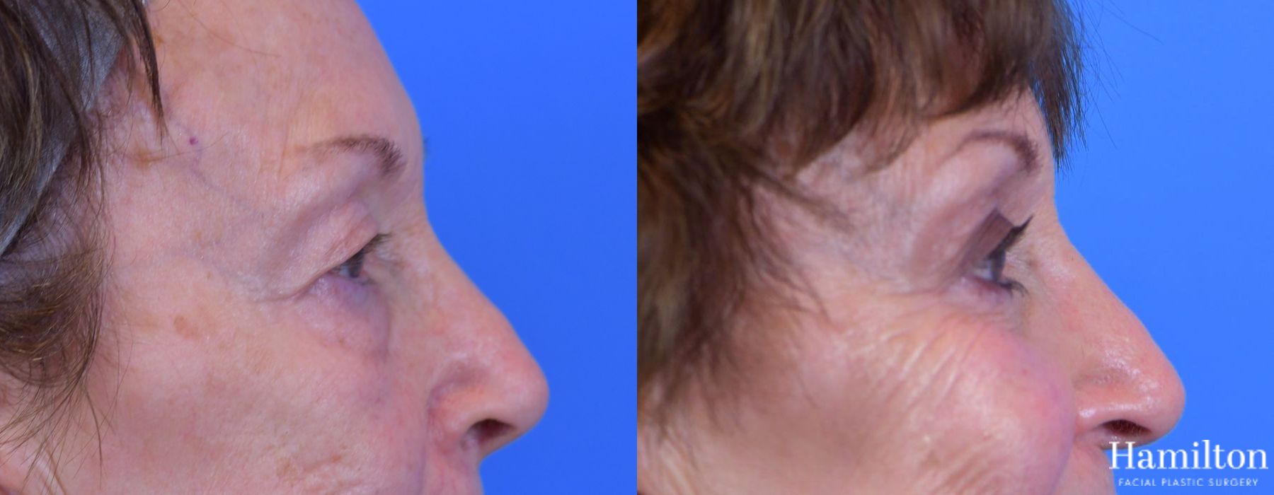 Before and after Blepharoplasty case 37297 - Angle 3