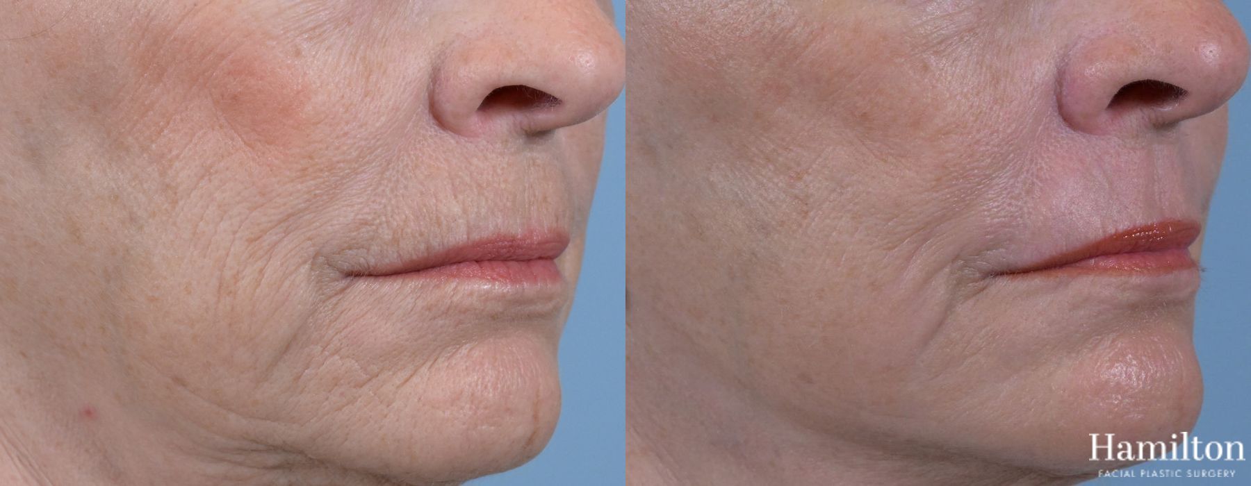 Before and after Laser - Sciton case 37118 - Angle 3