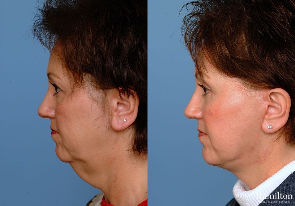 Before and after Facelift case 37283