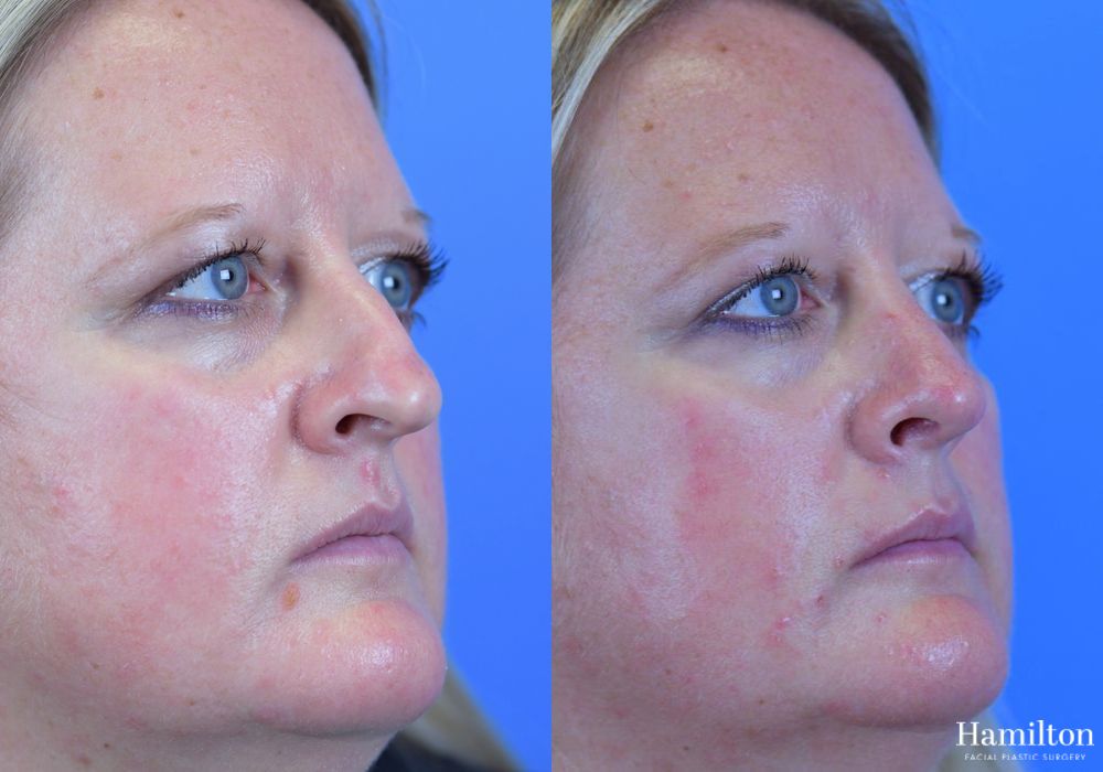 Before and after Rhinoplasty case 37311 - Angle 3