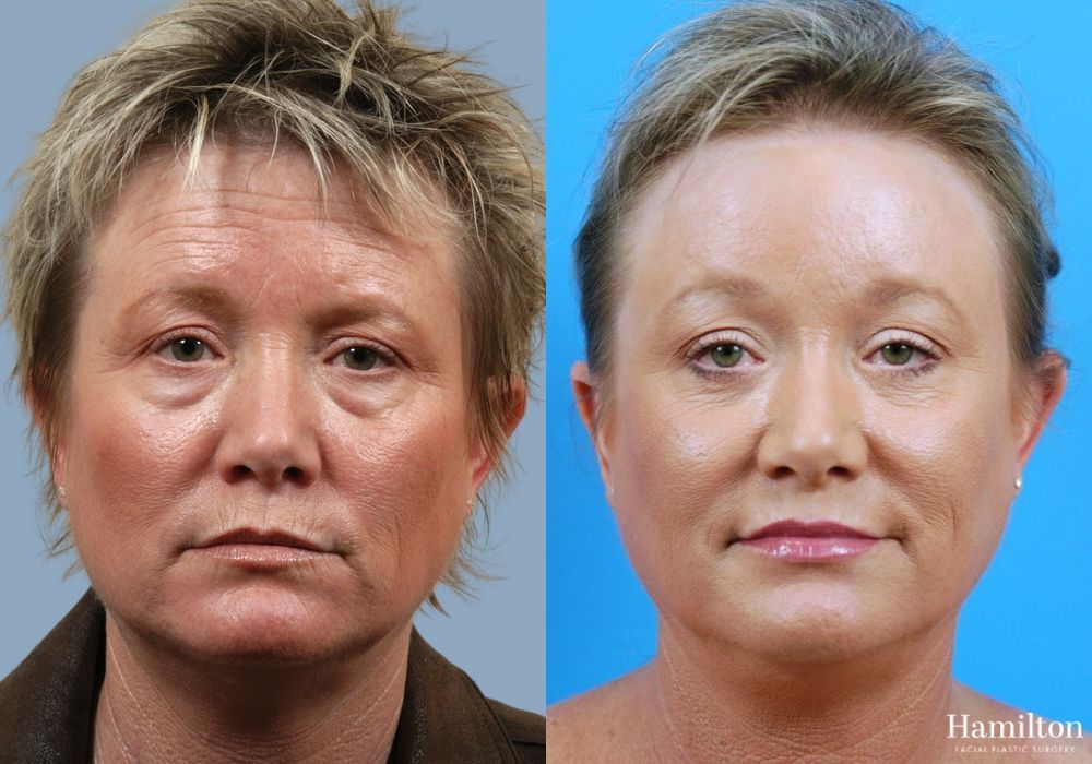 Before and after Brow Lift case 37248