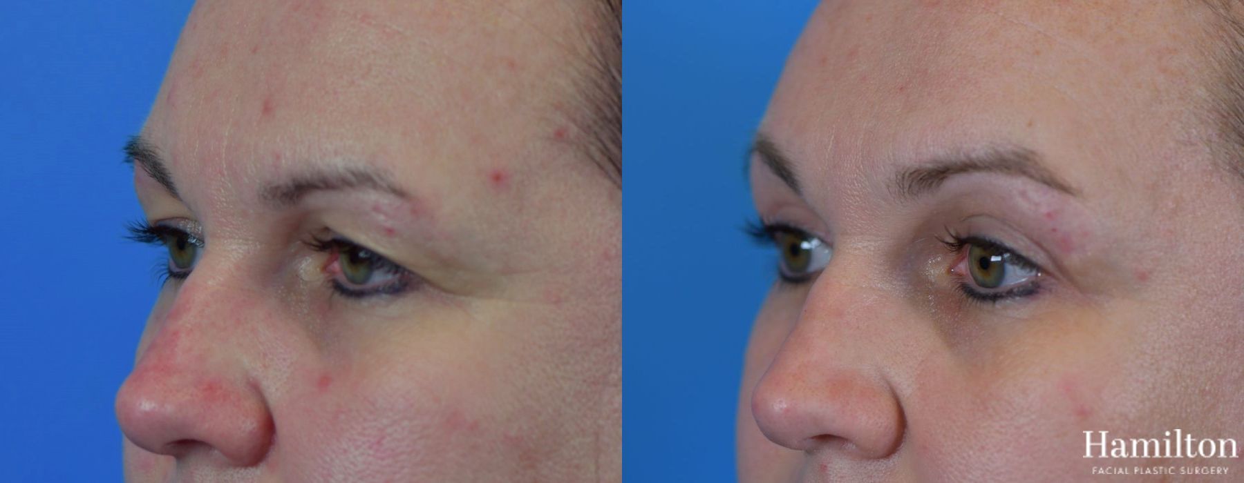 Before and after Blepharoplasty case 37304 - Angle 2