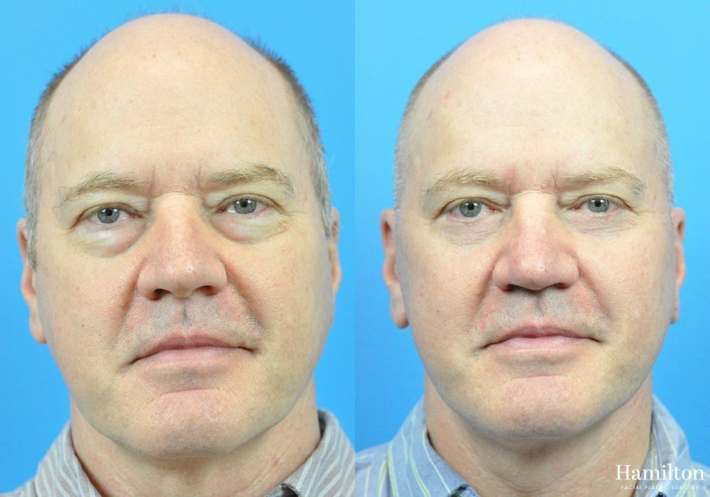 Before and after Facelift case 37306 - Angle 2