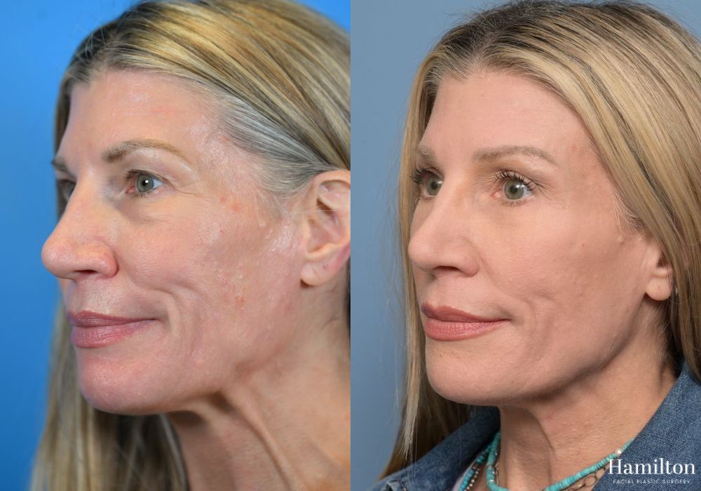 Before and after Brow Lift case 37196 - Angle 3