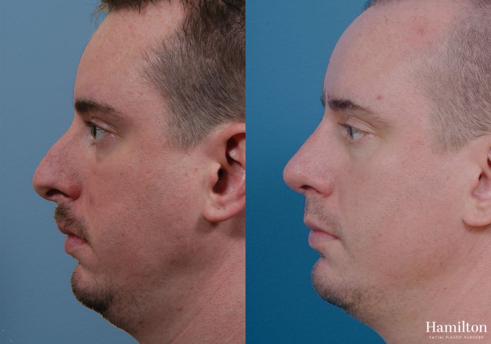Before and after Chin Augmentation case 37207