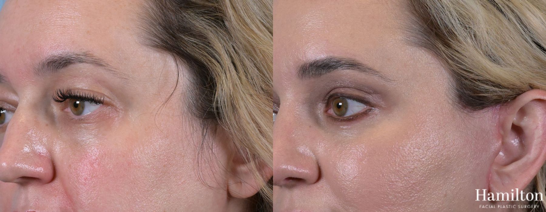 Before and after Blepharoplasty case 37133 - Angle 4