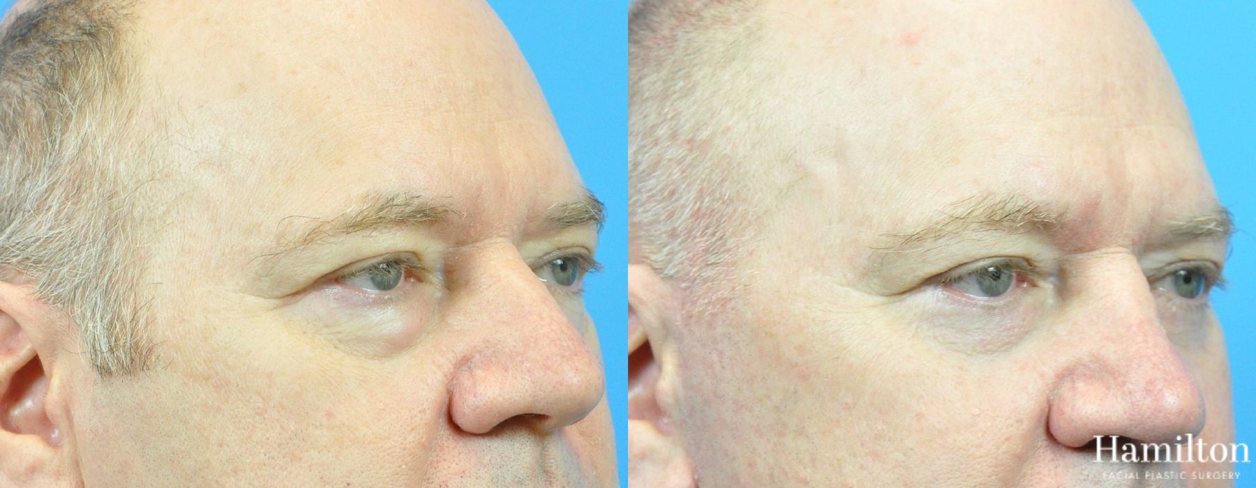 Before and after Blepharoplasty case 37282 - Angle 3