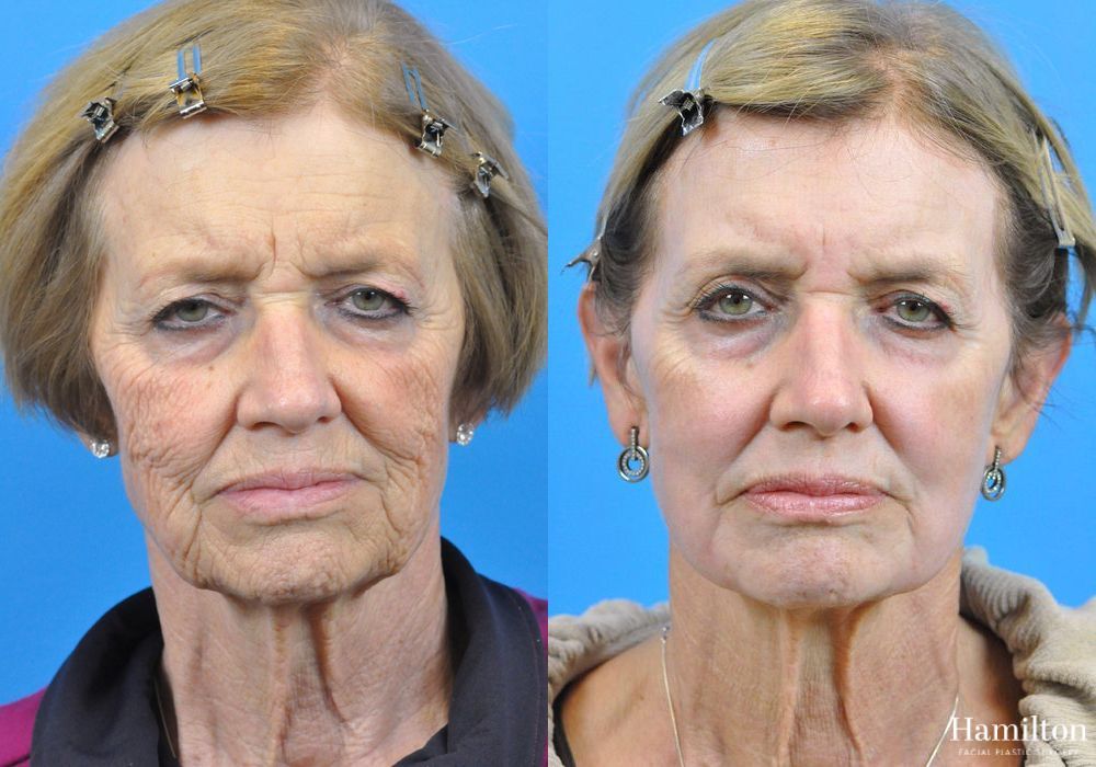 Before and after Laser - CO2 case 37170 - Angle 3