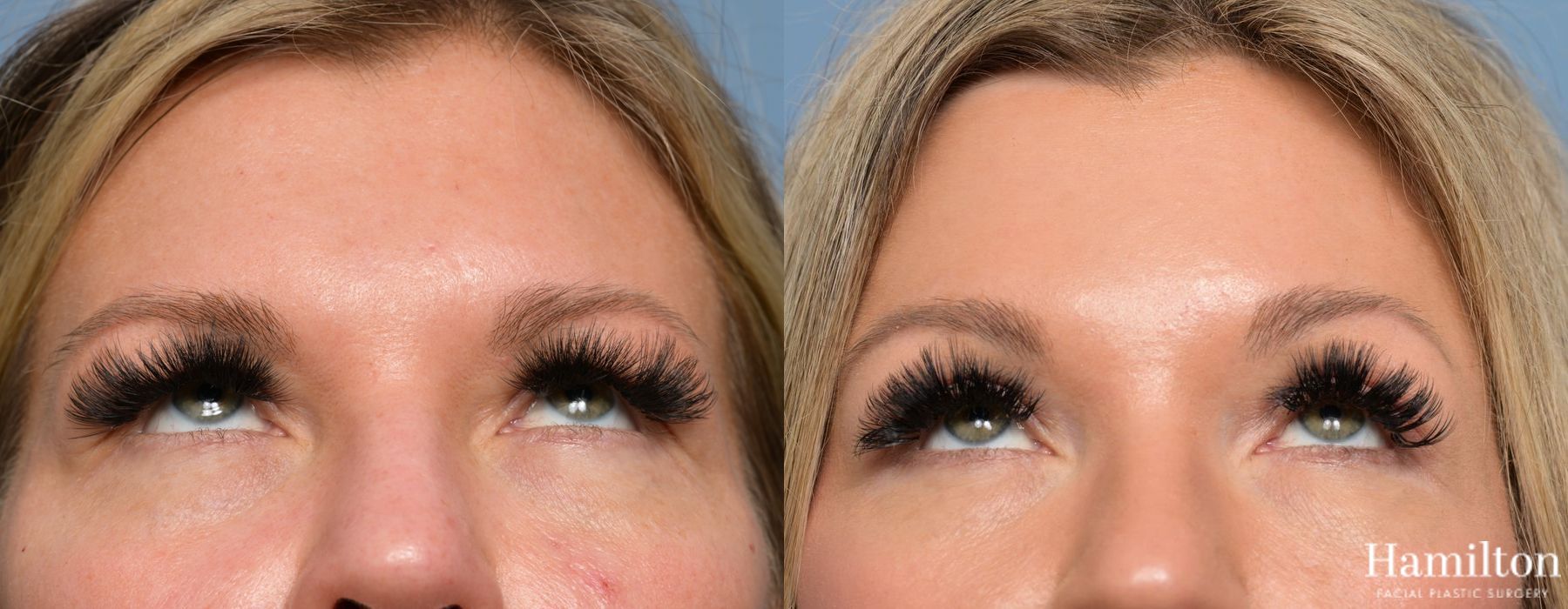 Before and after Blepharoplasty case 37156 - Angle 4