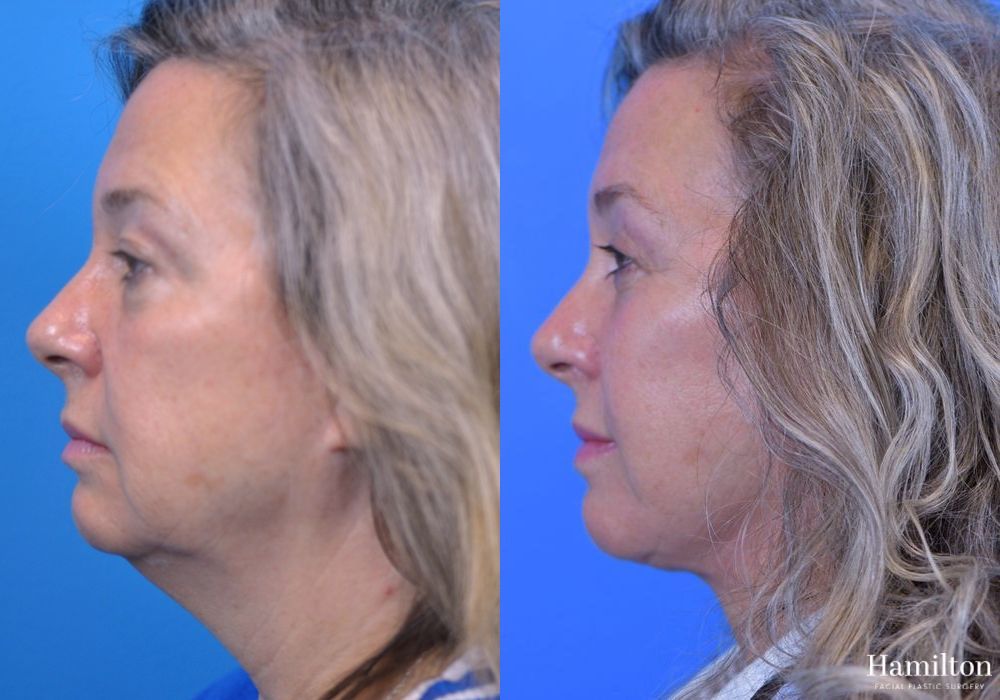 Before and after Facelift case 37294 - Angle 4
