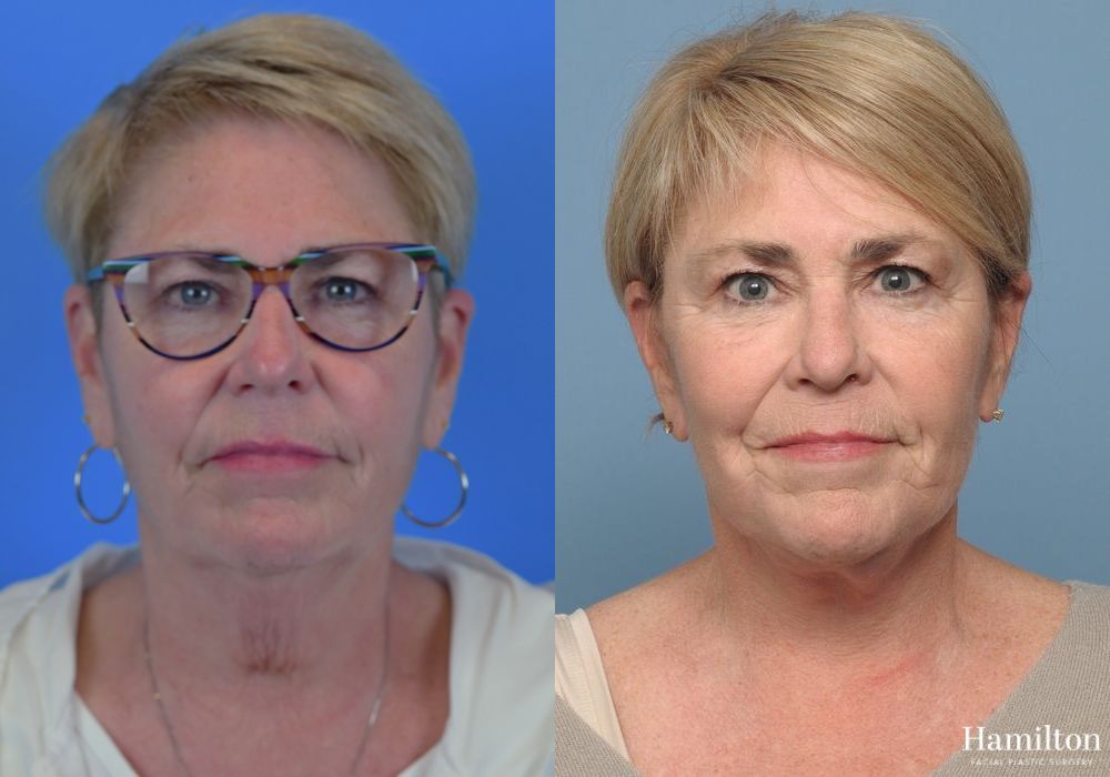 Before and after Neck Rejuvenation case 37234 - Angle 4