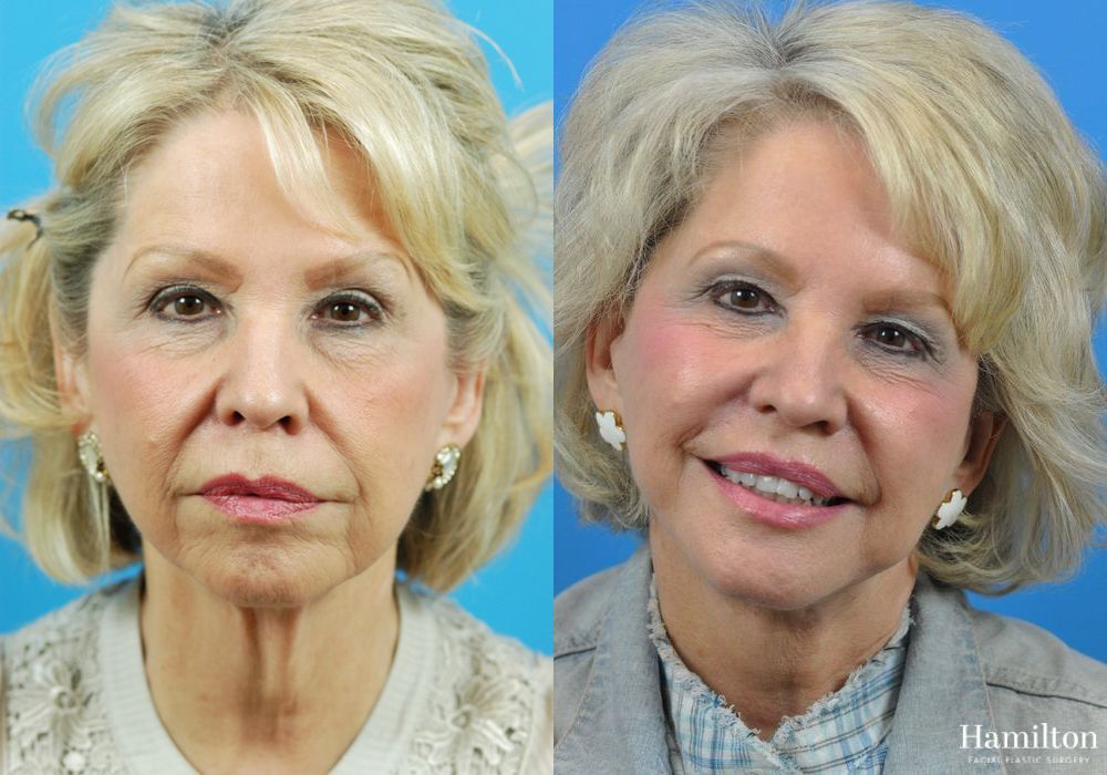 Before and after Facelift case 37314 - Angle 5