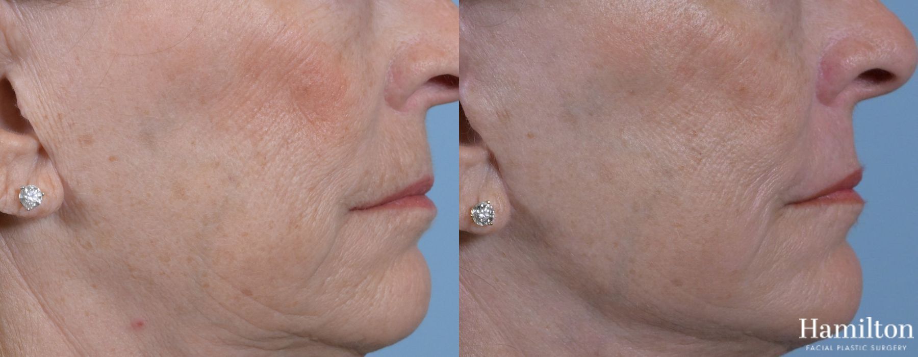 Before and after Laser - Sciton case 37118 - Angle 6