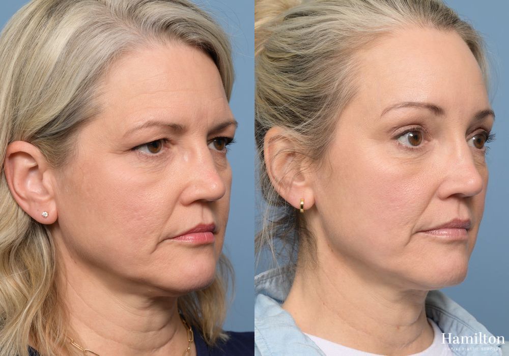 Before and after Brow Lift case 37117 - Angle 3