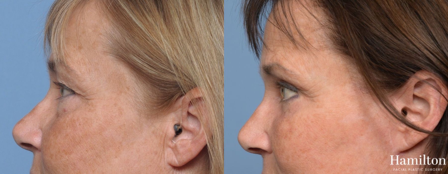 Before and after Blepharoplasty case 37256 - Angle 5