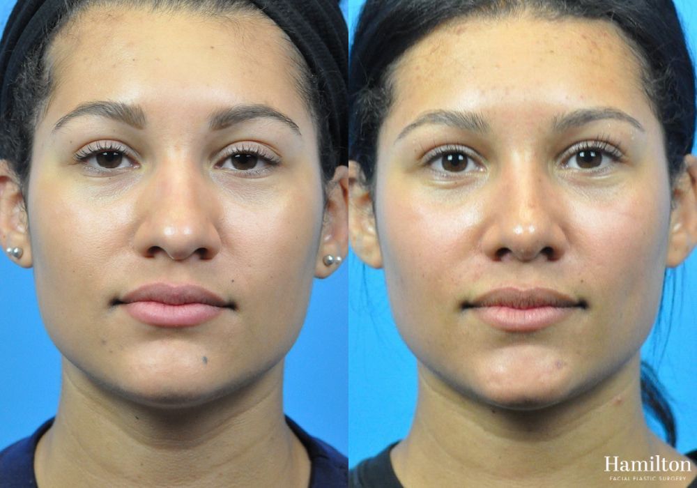 Before and after Rhinoplasty case 37331