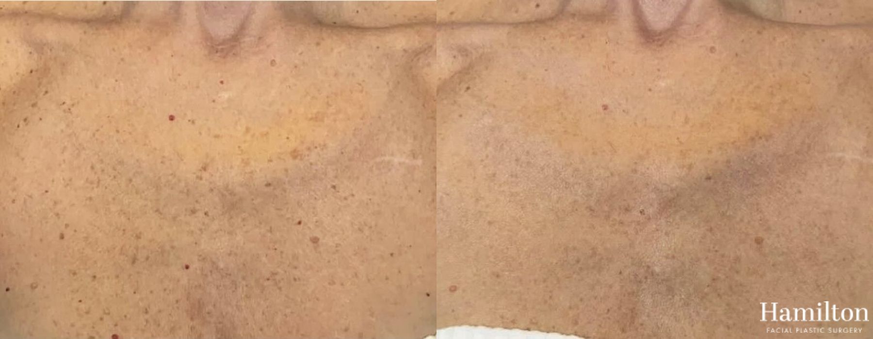 Before and after Laser - Broad Band Light (BBL) case 37183