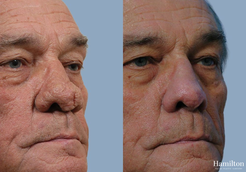 Before and after Rhinophyma case 37343 - Angle 2