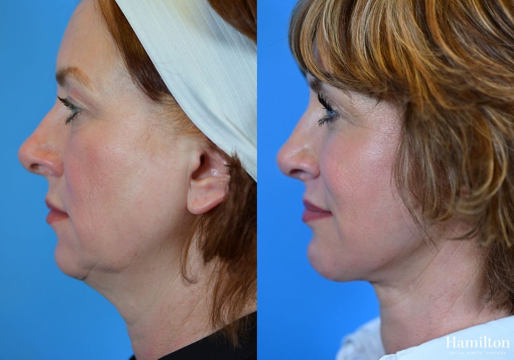 Before and after Chin Augmentation case 37130