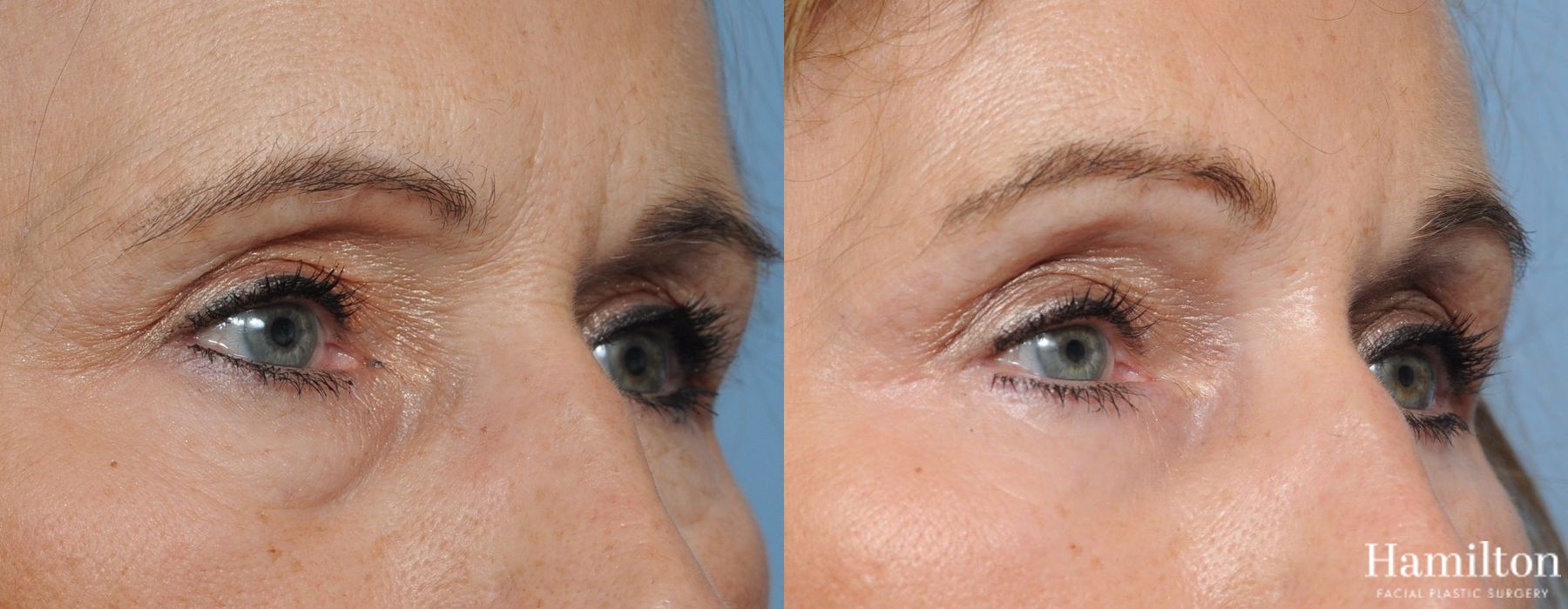 Before and after Blepharoplasty case 37263 - Angle 3
