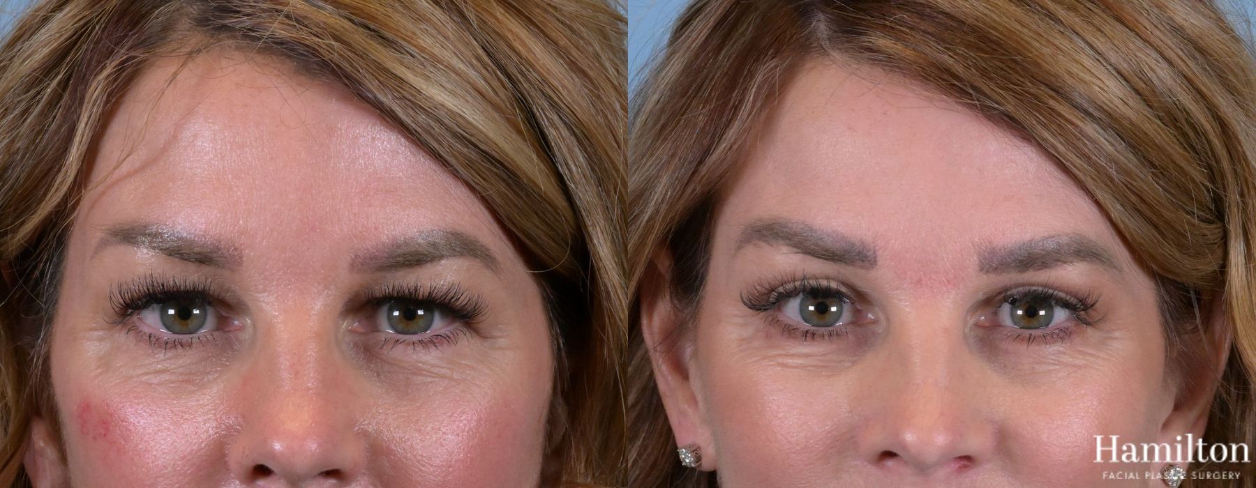 Before and after Blepharoplasty case 37185