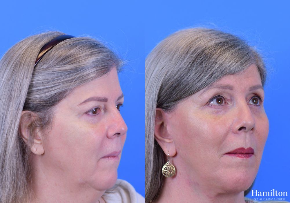 Before and after Facelift case 37278 - Angle 5