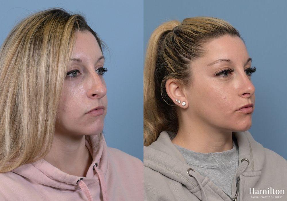 Before and after Rhinoplasty case 37239 - Angle 3