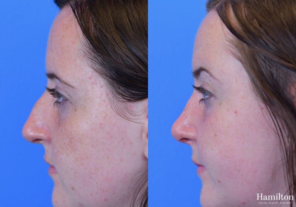 Before and after Rhinoplasty case 37339