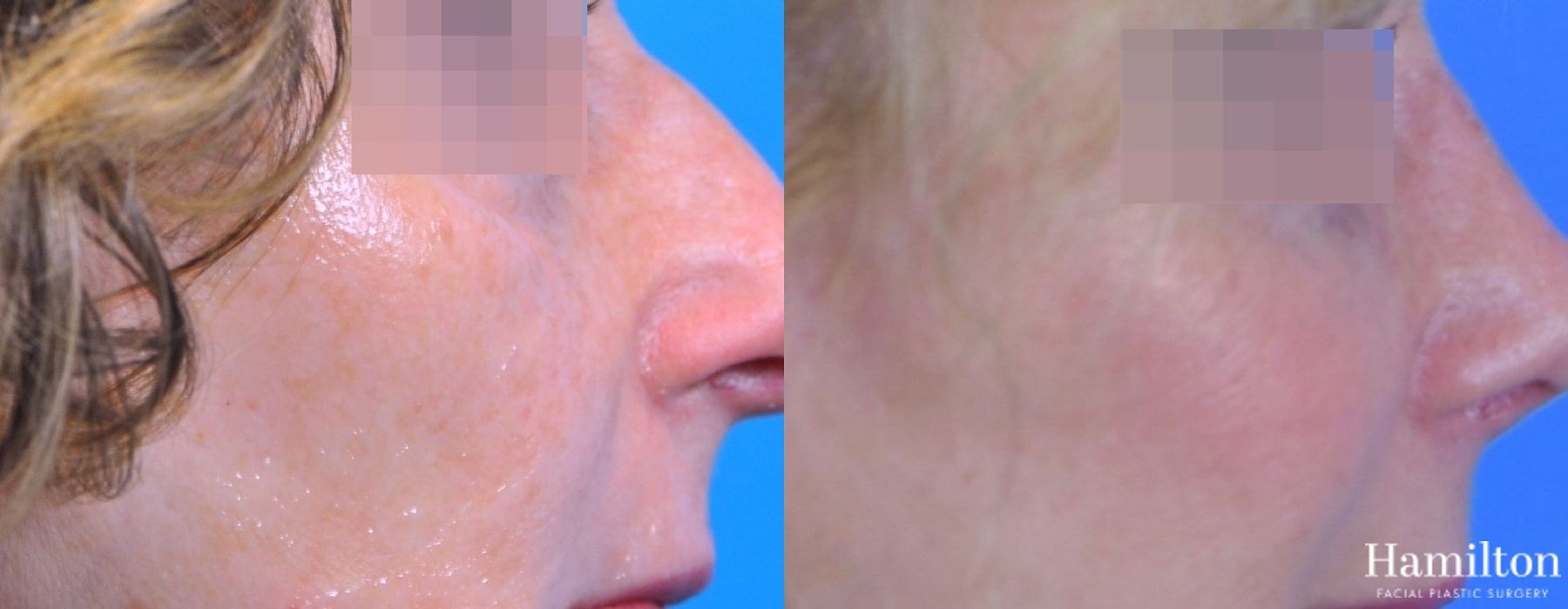 Before and after Rhinoplasty case 37352