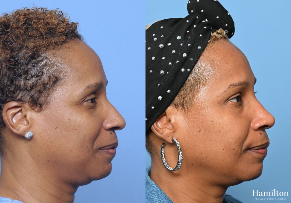 Before and after Rhinoplasty case 37298