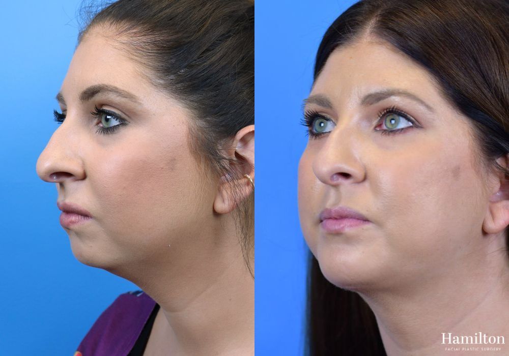 Before and after Chin Augmentation case 37218 - Angle 2
