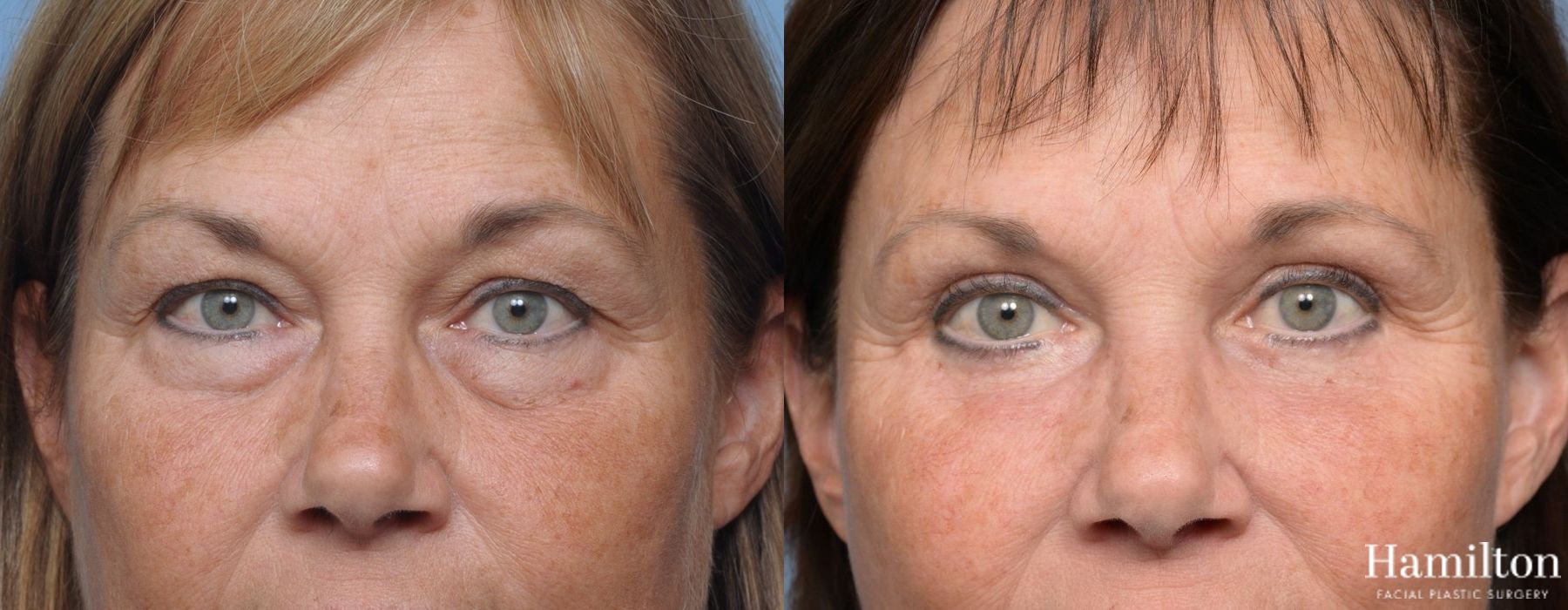 Before and after Blepharoplasty case 37256