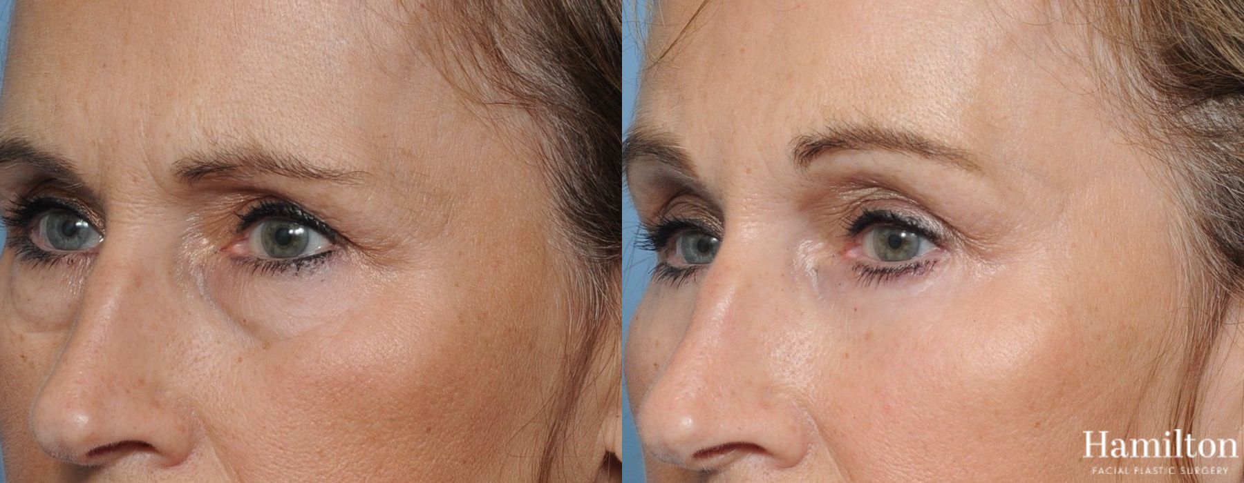 Before and after Blepharoplasty case 37305 - Angle 2