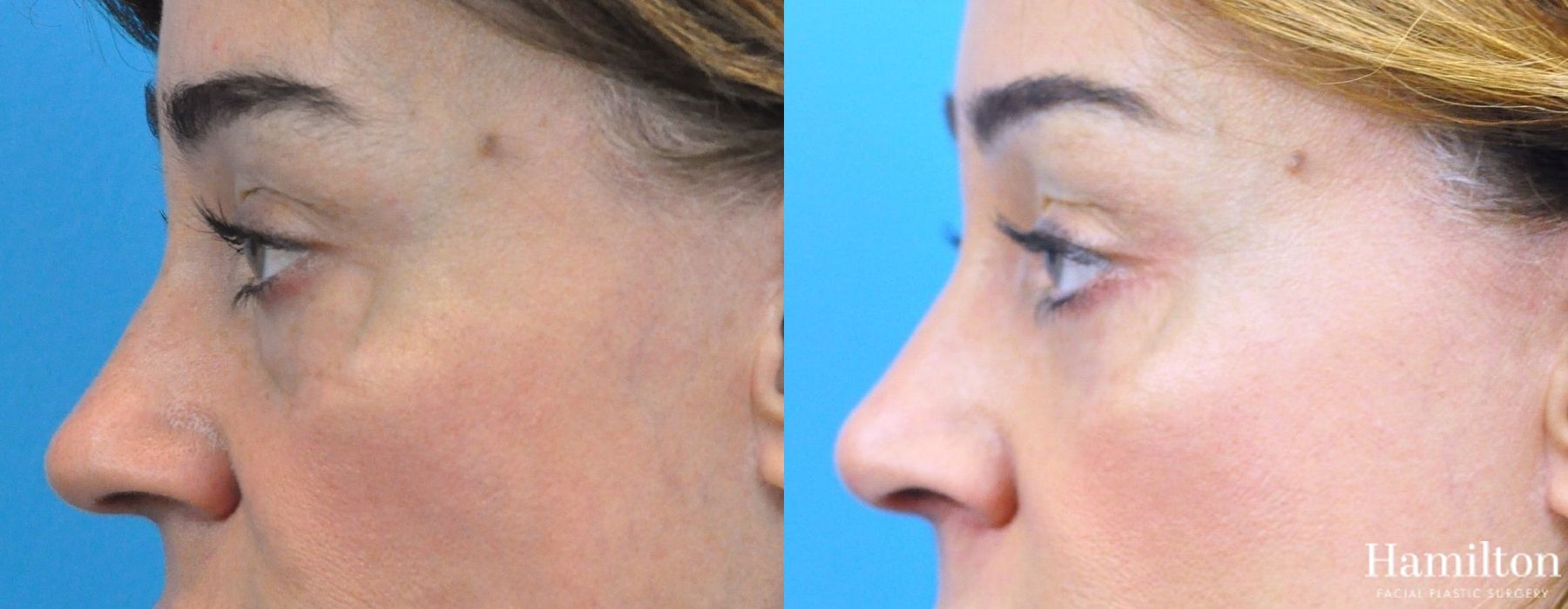 Before and after Rhinoplasty case 37329 - Angle 2