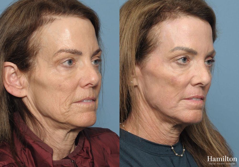 Before and after Laser - CO2 case 37150 - Angle 4