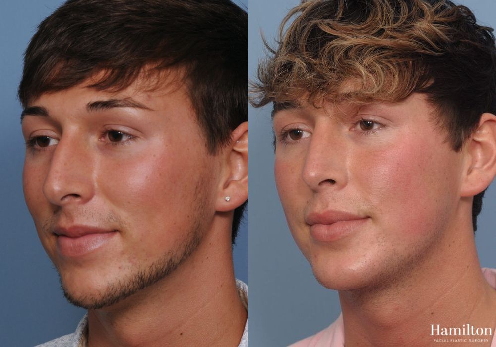 Before and after Rhinoplasty case 37293 - Angle 3