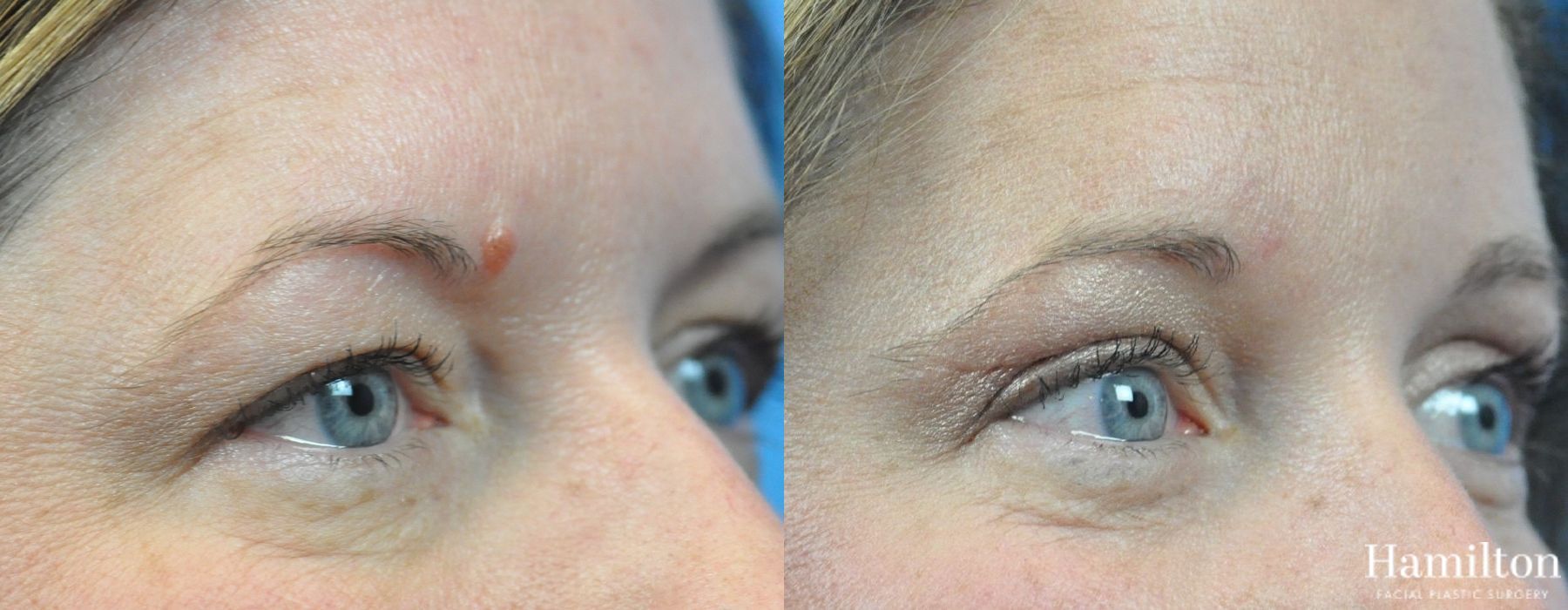 Before and after Blepharoplasty case 37307 - Angle 3