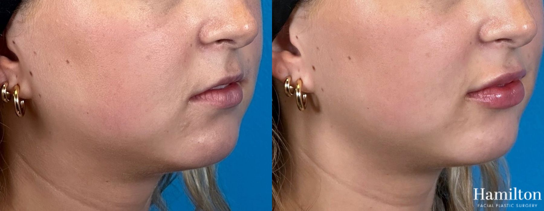 Before and after Lip Enhancement case 37106 - Angle 2