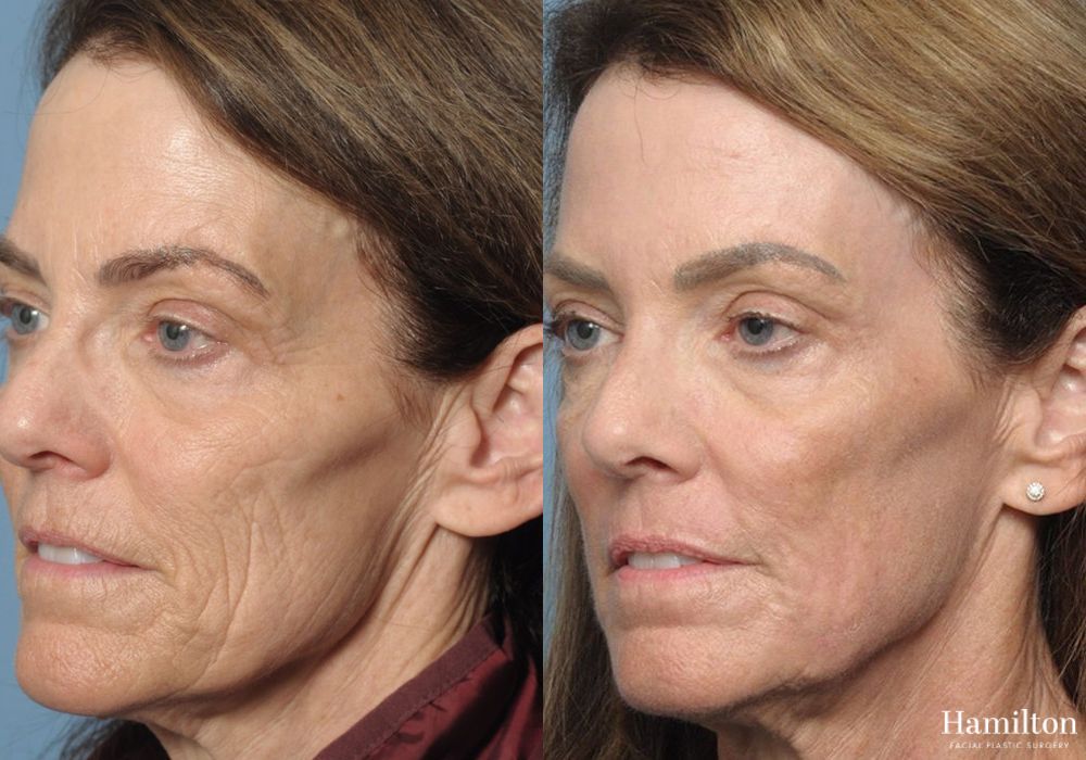 Before and after Laser - CO2 case 37150 - Angle 3