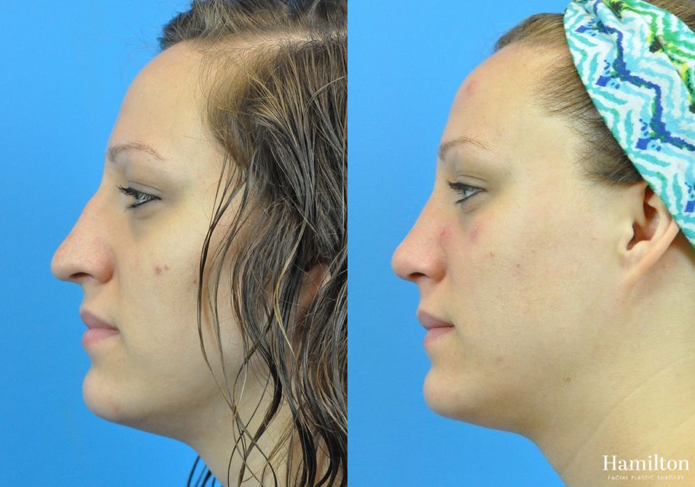 Before and after Rhinoplasty case 37357