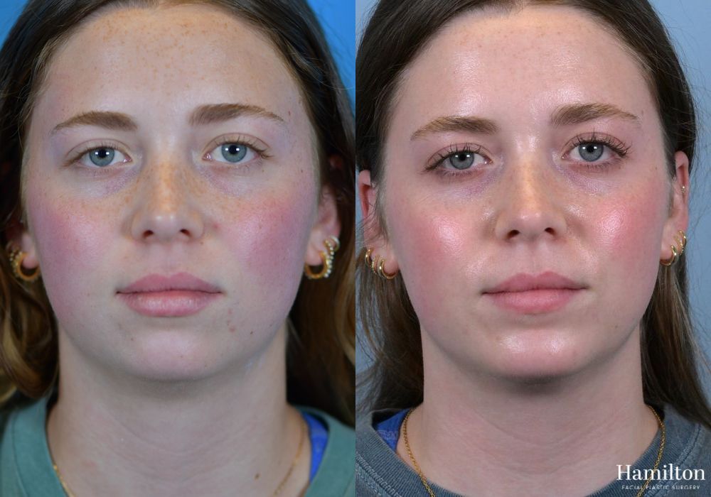 Before and after Chin Augmentation case 37176 - Angle 2
