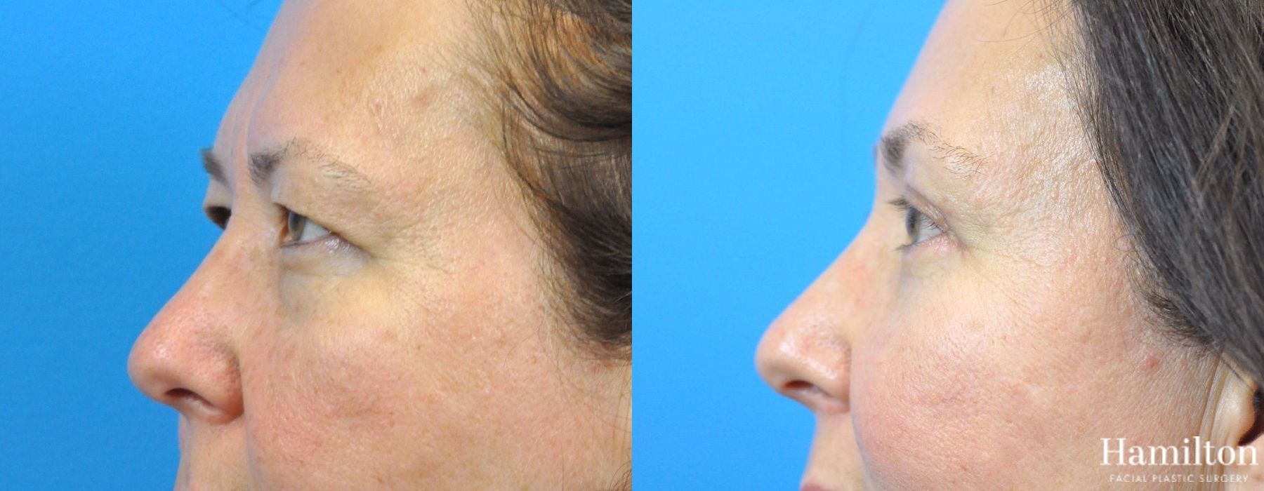 Before and after Blepharoplasty case 37308 - Angle 5