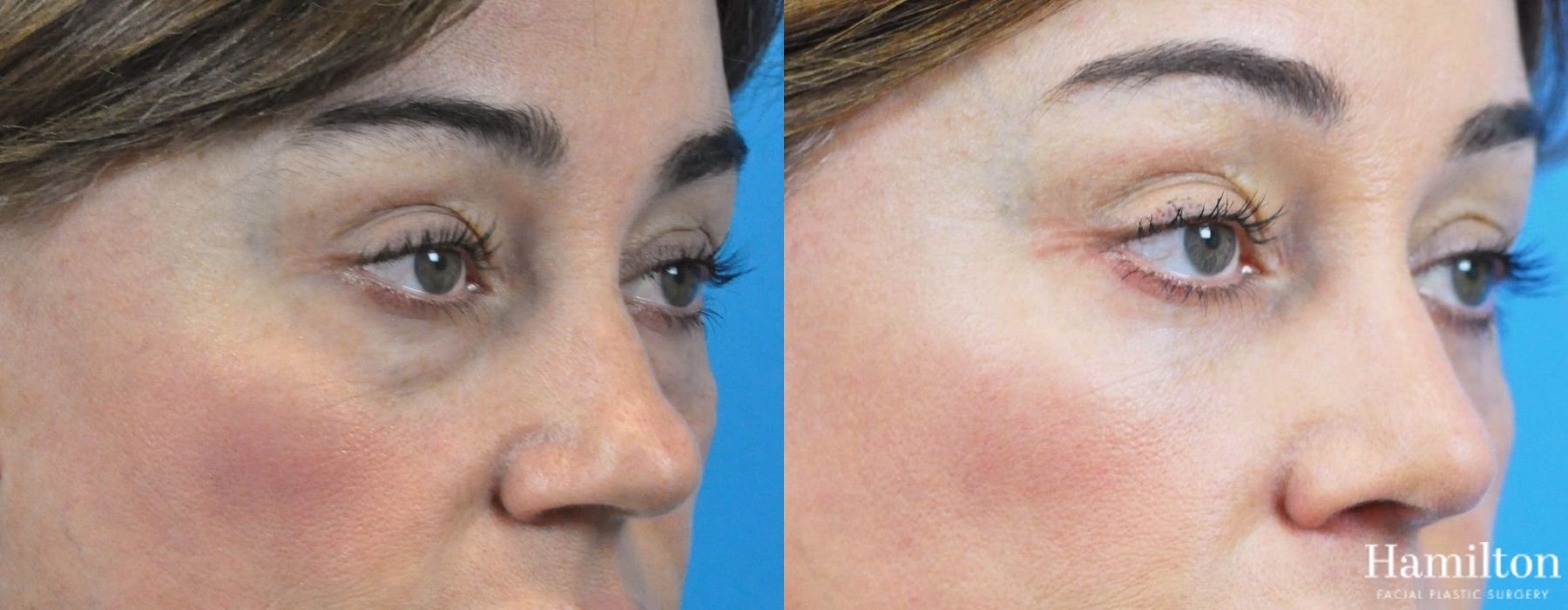 Before and after Rhinoplasty case 37329