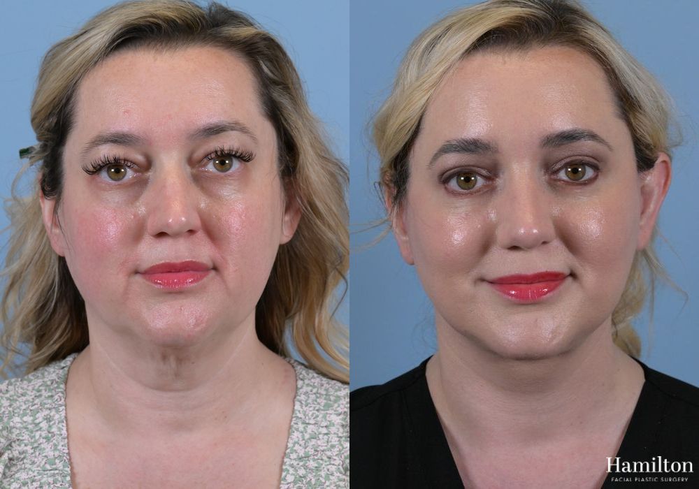 Before and after Rhinoplasty case 37276 - Angle 5