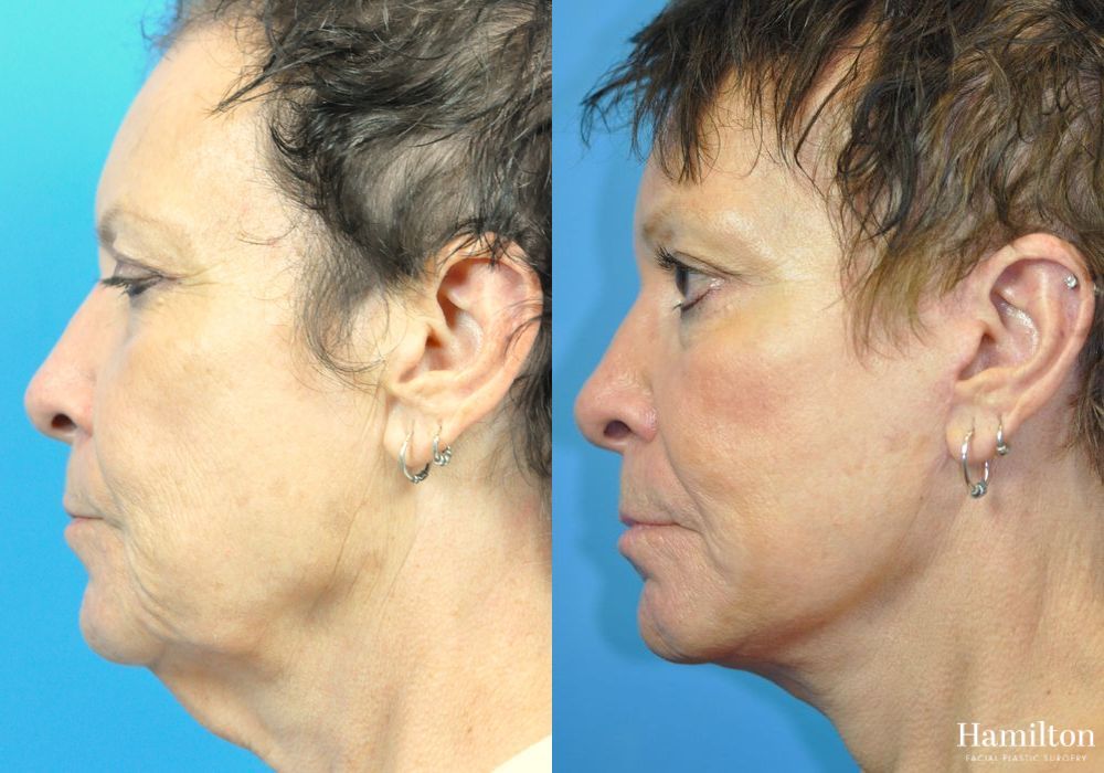 Before and after Brow Lift case 37232 - Angle 3