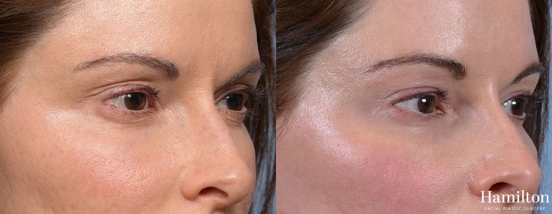 Before and after Blepharoplasty case 37169 - Angle 2