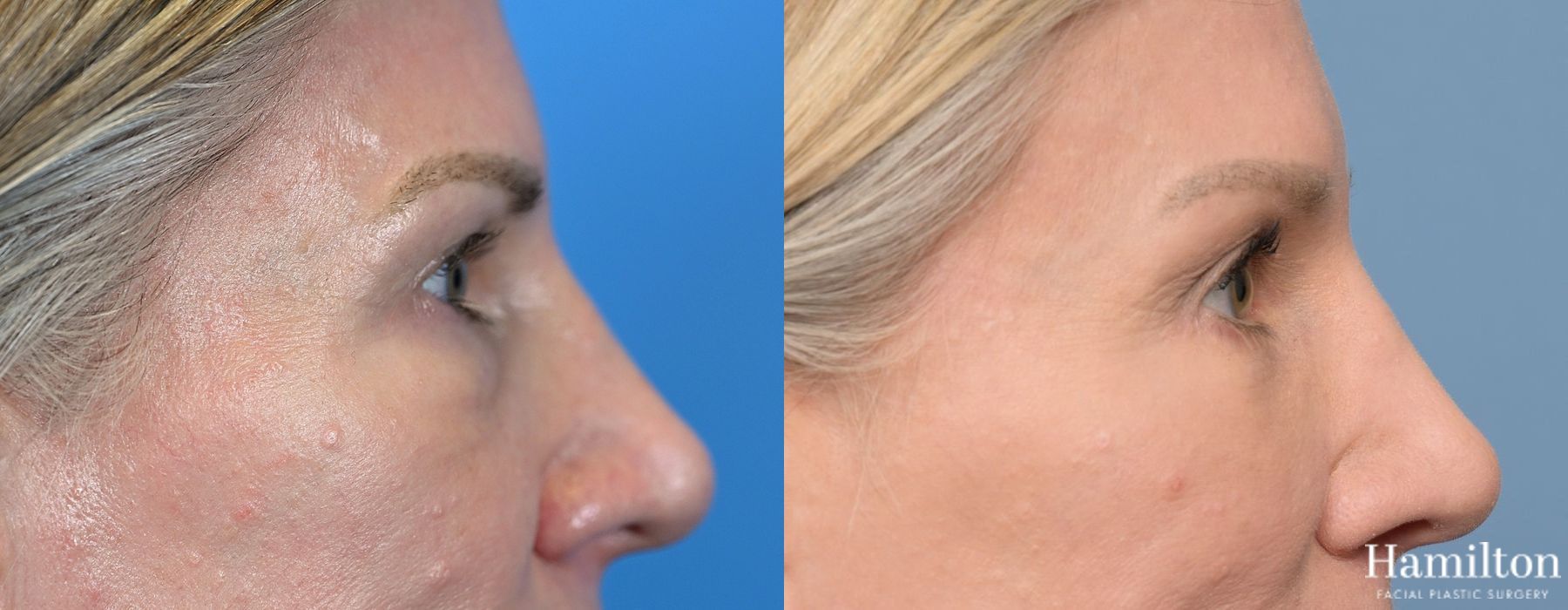 Before and after Blepharoplasty case 37257 - Angle 5